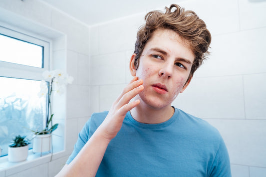 acne giovanile